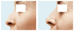 Grzbiet nosa - wypełnianie preparatem Radiesse przed i po zabiegu