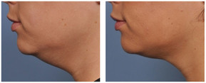 Ulthera - lifting twarzy i ciała przed i po zabiegu