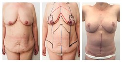 Jednoczesna korekcja piersi i brzucha (mommy makeover) przed i po zabiegu