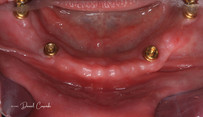 Protezy zębowe przed i po zabiegu