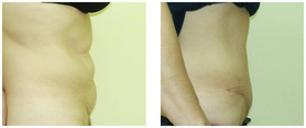Chirurgia plastyczna ciała i modelowanie sylwetki przed i po zabiegu