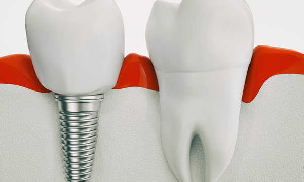 Implanty zębowe Straumann