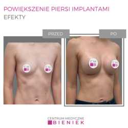 Powiększenie piersi implantami - efekty
