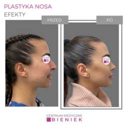Plastyka nosa - efekty 