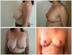 Zmniejszenie piersi - przed i po
