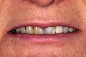 Przypadek 1. Pacjentka chciała poprawić estetykę przednich zębów oraz odbudować brakujące zęby. Problem stanowiły zęby przednie leczone kanałowo i przebarwione oraz liczne wypełnienia nie pasujące barwą do własnych zębów.