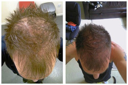 Leczenie łysienia przed i po zabiegu