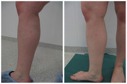 Leczenie żylaków nóg przed i po zabiegu
