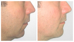 Modelowanie brody implantami przed i po zabiegu