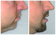Modelowanie brody implantami przed i po zabiegu
