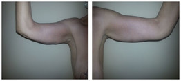 Plastyka ramion przed i po zabiegu