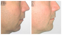 Profiloplastyka twarzy - implanty przed i po zabiegu
