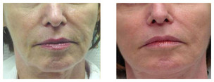 Exilis - odmładzanie twarzy / likwidacja tkanki tłuszczowej / modelowanie sylwetki / ujędrnianie zwiotczałej skóry przed i po zabiegu
