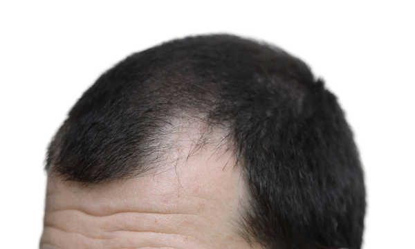 Mikropigmentacja skóry głowy (HFS) sposobem na łysienie