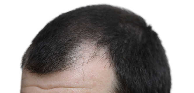 Mikropigmentacja skóry głowy (HFS) sposobem na łysienie
