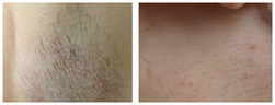 Pachy - epilacja laserowa przed i po zabiegu