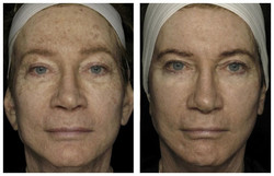 Cała twarz  - usuwanie przebarwień laserem przed i po zabiegu