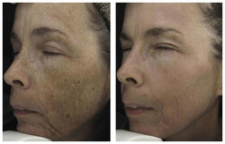 Cała twarz  - usuwanie przebarwień laserem przed i po zabiegu