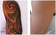 Laserowe usuwanie tatuaży przed i po zabiegu