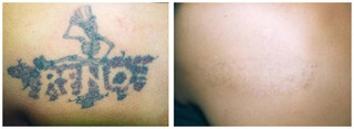 Mały tatuaż - usuwanie laserem przed i po zabiegu