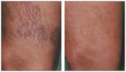Nogi - usuwanie popękanych naczynek laserem przed i po zabiegu