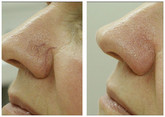 Nos - usuwanie popękanych naczynek laserem przed i po zabiegu