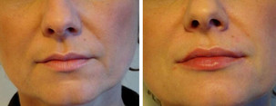 Operacje plastyczne ust przed i po zabiegu