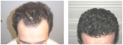 Przeszczep włosów metodą FUE SAFER u mężczyzn przed i po zabiegu