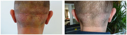 Przeszczep włosów metodą FUE SAFER u mężczyzn przed i po zabiegu