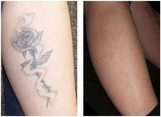 Średni tatuaż - usuwanie laserem przed i po zabiegu