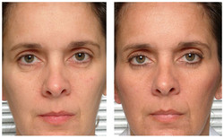 Thermage - lifting twarzy i ciała przed i po zabiegu