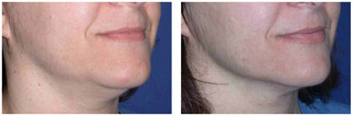 Ulthera - lifting twarzy i ciała przed i po zabiegu
