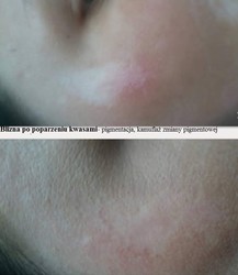 Blizny - pigmentacja medyczna przed i po zabiegu