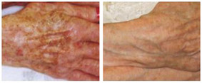 Dłonie - usuwanie przebarwień laserem przed i po zabiegu