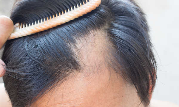 Przeszczep włosów FUT - co to za zabieg?