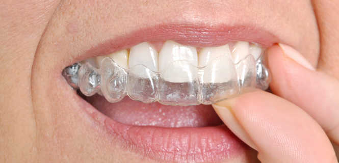 Aparat ortopedyczny na zęby cena