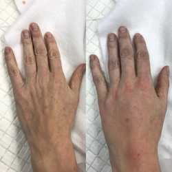 Modelowanie dłoni własnym tłuszczem przed i po zabiegu
