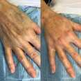 Modelowanie dłoni własnym tłuszczem przed i po zabiegu