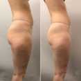Modelowanie sylwetki i usuwanie cellulitu (lipomasaż) przed i po zabiegu