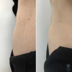 Lipoliza iniekcyjna - usuwanie tkanki tłuszczowej przed i po zabiegu