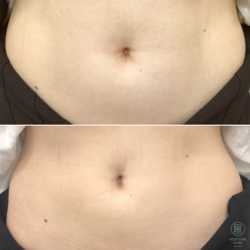 Lipoliza iniekcyjna - usuwanie tkanki tłuszczowej przed i po zabiegu