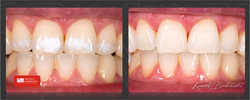 Metoda Icon pozwala na delikatne leczenie bez borowania trudno dostępnych zmian na powierzchniach zębów bez zbędnej utraty ich zdrowych twardych tkanek