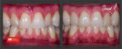 minimalnie inwazyjna odbudowa kompozytowa utraconych tkanek zęba w celu poprawy estetyki uśmiechu