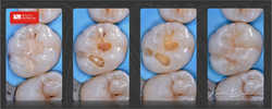 minimalnie inwazyjna stomatologia zachowawcza umożliwia leczenie i zachowanie jak największej ilości własnych tkanek zęba
