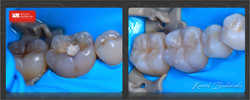 odbudowa zębów biomimetyczna z zachowaniem idealnej anatomii