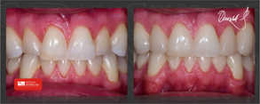 minimalnie inwazyjna odbudowa kompozytowa utraconych tkanek zęba w celu poprawy estetyki uśmiechu