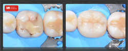 (inlay, onlay, overlay) wykonany z materiału kompozytowego idealnie odwzorowuje utracone twarde tkanki zęba