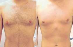 Klatka piersiowa - epilacja laserowa przed i po zabiegu