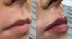 Powiększanie ust kwasem hialuronowym przed i po zabiegu