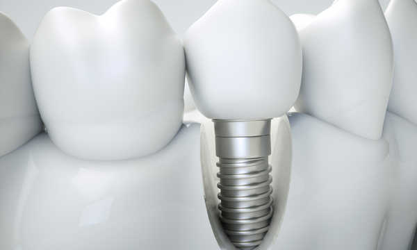 Implanty zębowe Biomet 3i